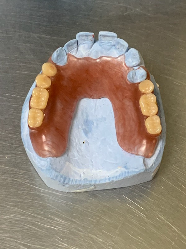 Flexible Partial Denture