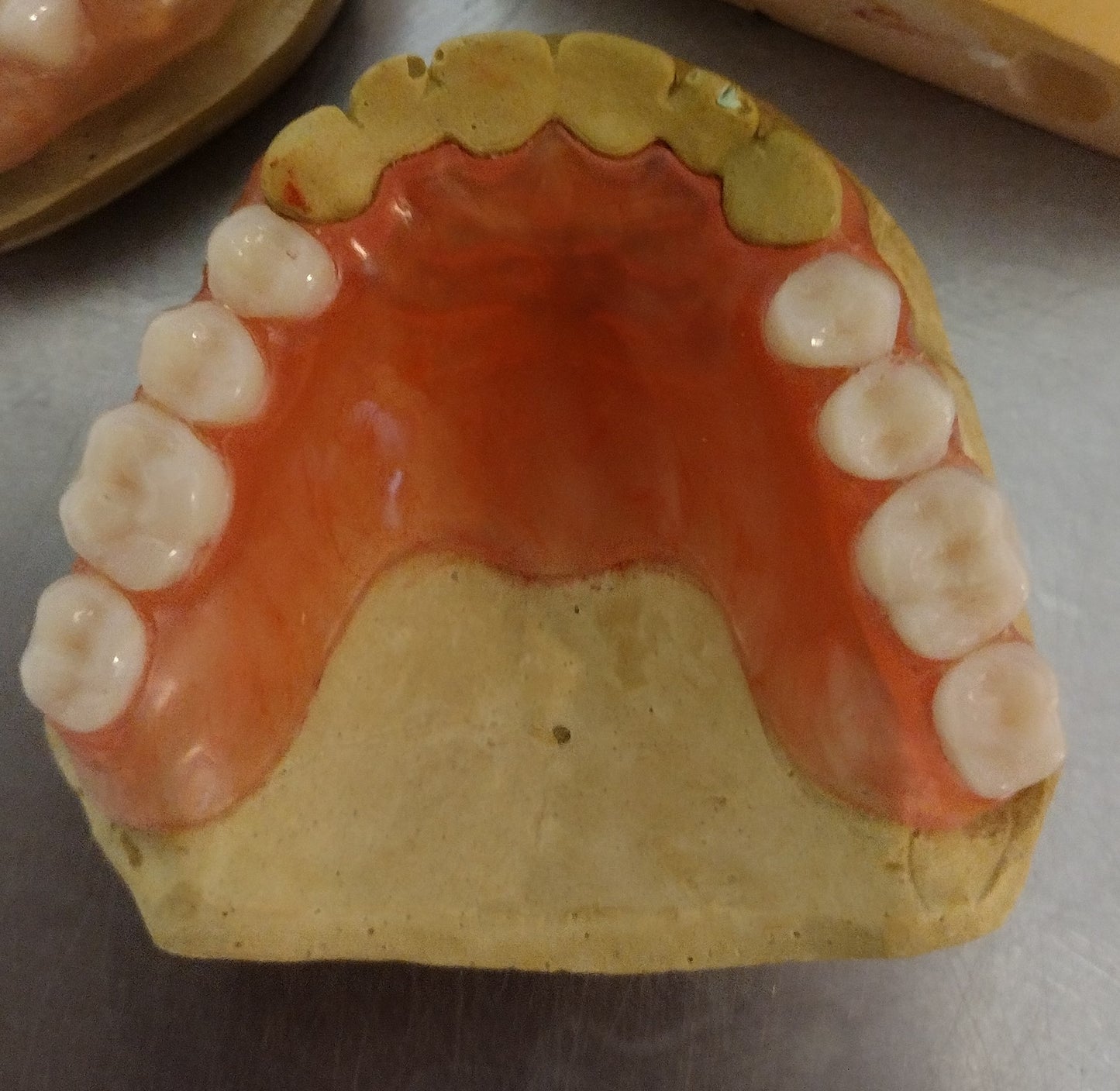 Flexible Partial Denture